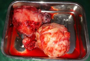 Fibroid and hysterectomy specimen